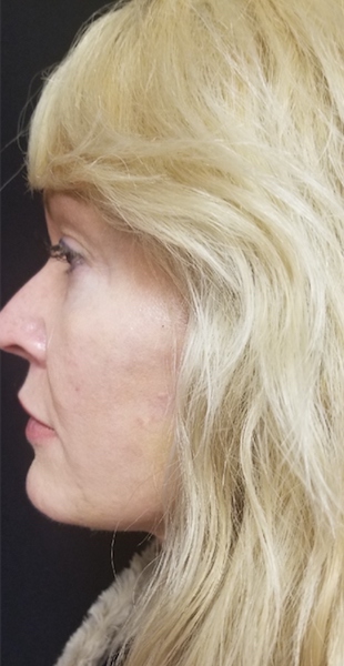 Facelift and Necklift Before & After Patient #10054