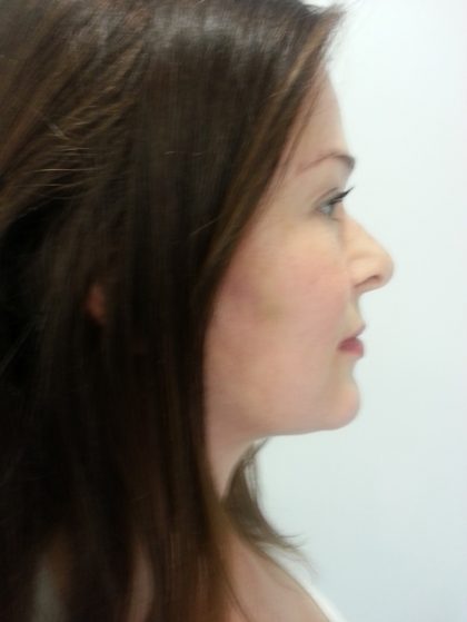 Facelift and Necklift Before & After Patient #10042