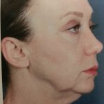Facelift and Necklift Before & After Patient #10045