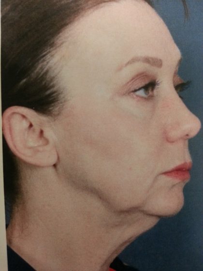 Facelift and Necklift Before & After Patient #10045