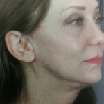 Facelift and Necklift Before & After Patient #10045