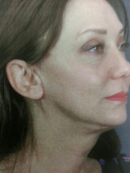 Facelift and Necklift Before & After Patient #10045