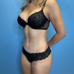 Tummy Tuck Before & After Patient #10090