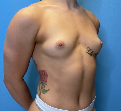 Breast Augmentation Before & After Patient #10236