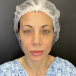 Facelift and Necklift Before & After Patient #10258