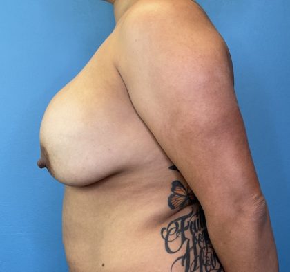 Breast Lift / Mannequin Breast Lift Before & After Patient #10214