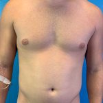 Liposuction Before & After Patient #10269