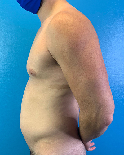 Liposuction Before & After Patient #10269