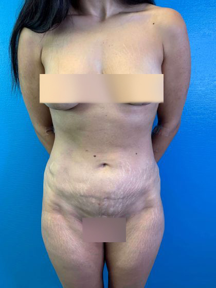 Tummy Tuck Before & After Patient #10499