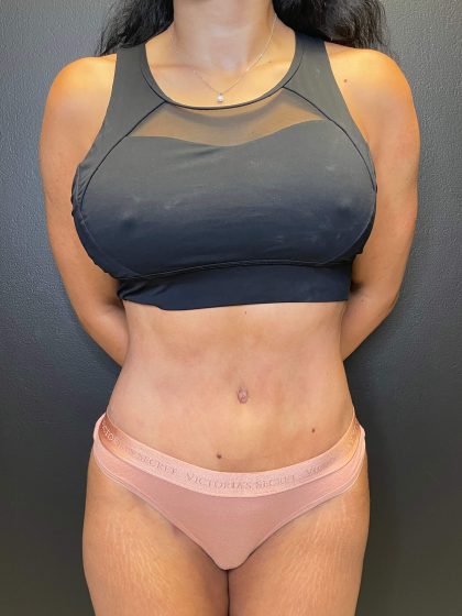 Tummy Tuck Before & After Patient #10499