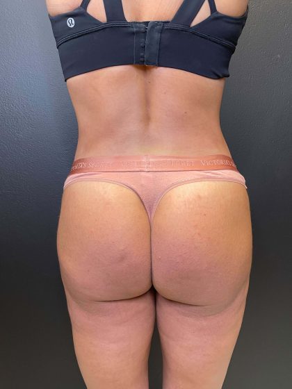 Brazilian Butt Lift Before & After Patient #11215