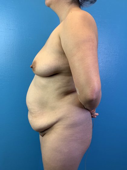 Brazilian Butt Lift Before & After Patient #10365