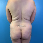 Brazilian Butt Lift Before & After Patient #10365