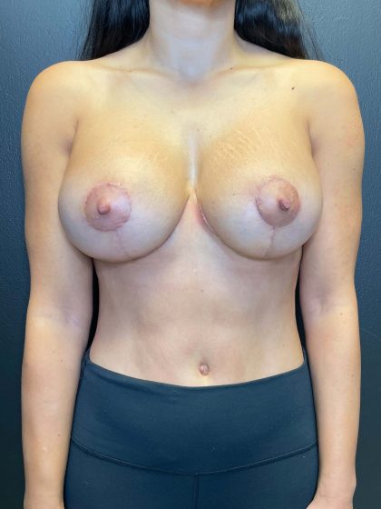 Breast Lift Before & After Patient #10488