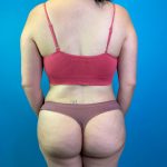 Brazilian Butt Lift Before & After Patient #10365