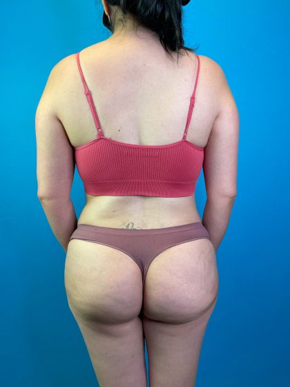 Brazilian Butt Lift Before & After Patient #10365