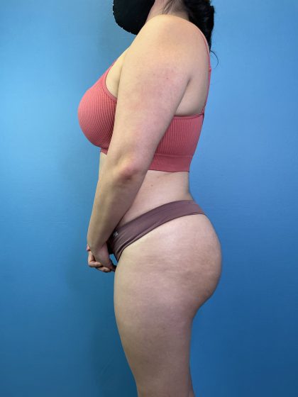 Brazilian Butt Lift Before & After Patient #10365