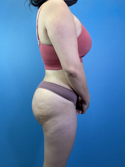 Brazilian Butt Lift Before & After Patient #10365