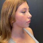 Rhinoplasty Before & After Patient #10431