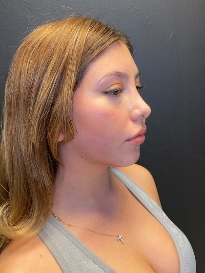 Rhinoplasty Before & After Patient #10431