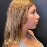Rhinoplasty Before & After Patient #10431