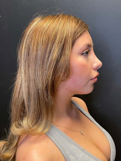 Rhinoplasty Before & After Patient #10431