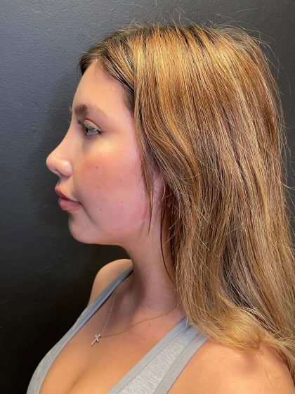 Rhinoplasty Before & After Patient #10431