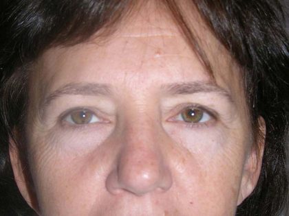 Blepharoplasty (Eyelid Surgery) Before & After Patient #10577
