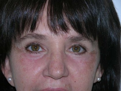 Blepharoplasty (Eyelid Surgery) Before & After Patient #10577