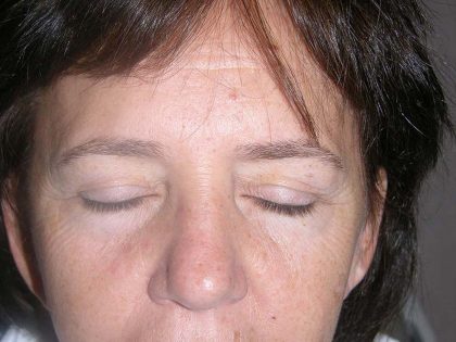 Blepharoplasty (Eyelid Surgery) Before & After Patient #10577