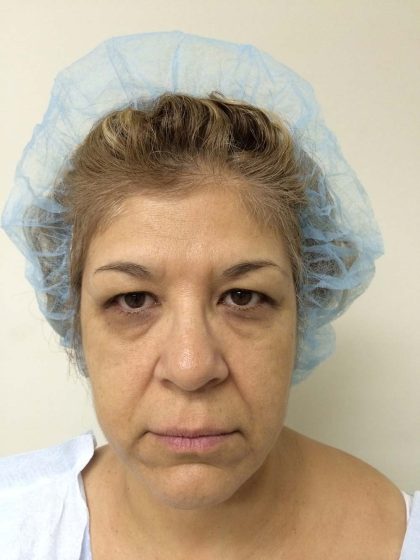 Blepharoplasty Before & After Patient #10594
