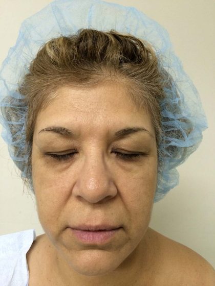 Blepharoplasty (Eyelid Surgery) Before & After Patient #10594