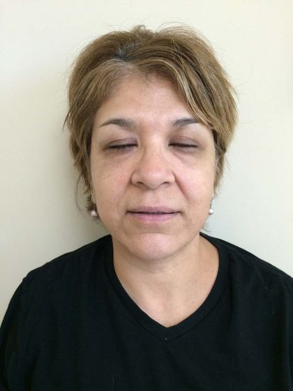 Blepharoplasty (Eyelid Surgery) Before & After Patient #10594