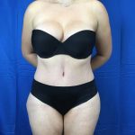 Tummy Tuck Before & After Patient #10582