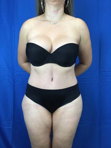 Tummy Tuck Before & After Patient #10582