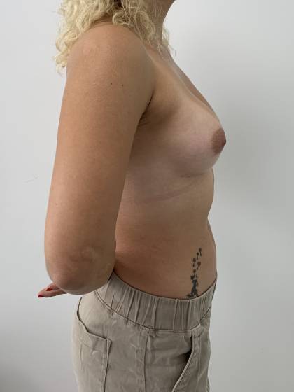 Breast Augmentation Before & After Patient #10733