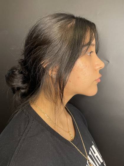 Rhinoplasty Before & After Patient #10664