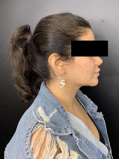 Neck and Chin Liposuction Before & After Patient #10709