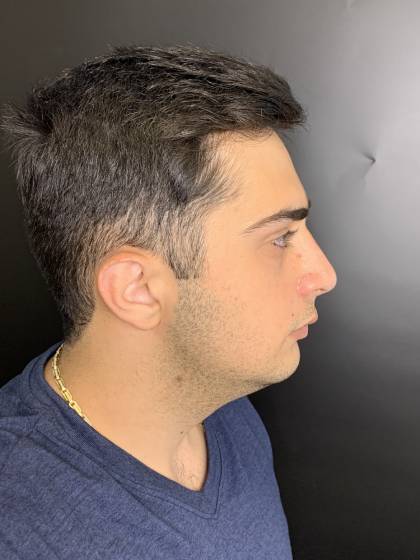 Rhinoplasty Before & After Patient #10675