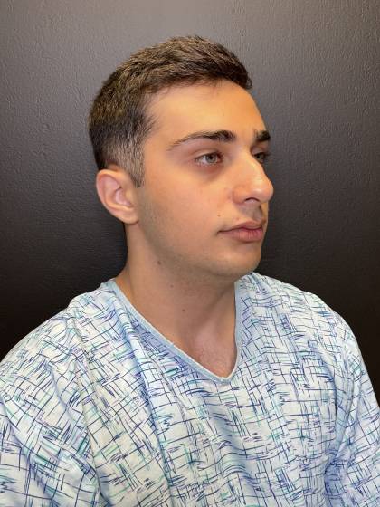 Rhinoplasty Before & After Patient #10675