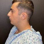 Rhinoplasty Before & After Patient #10675