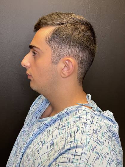 Rhinoplasty Before & After Patient #10675