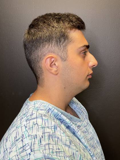 Rhinoplasty Before & After Patient #10675