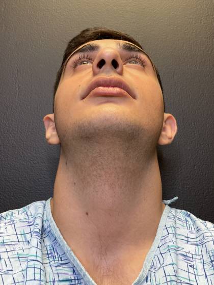 Rhinoplasty Before & After Patient #10675