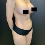 Liposuction Before & After Patient #10710