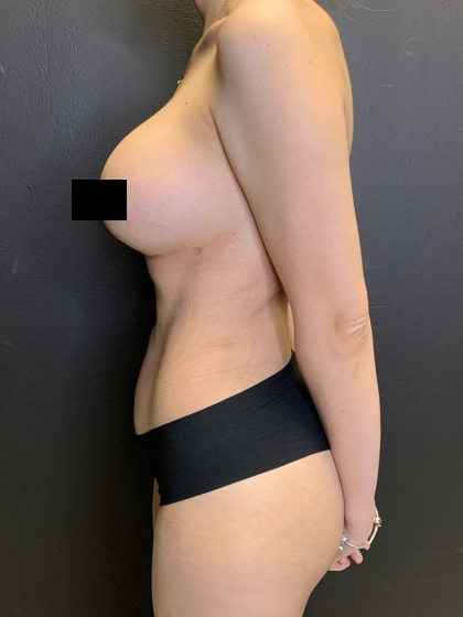 Liposuction Before & After Patient #10710