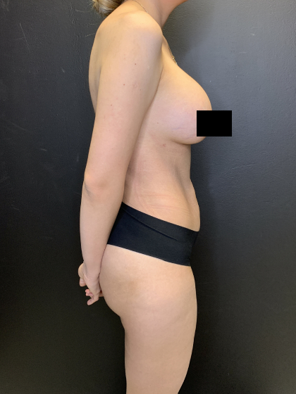 Liposuction Before & After Patient #10710