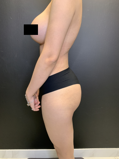 Brazilian Butt Lift Before & After Patient #10744