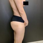 Brazilian Butt Lift Before & After Patient #10744