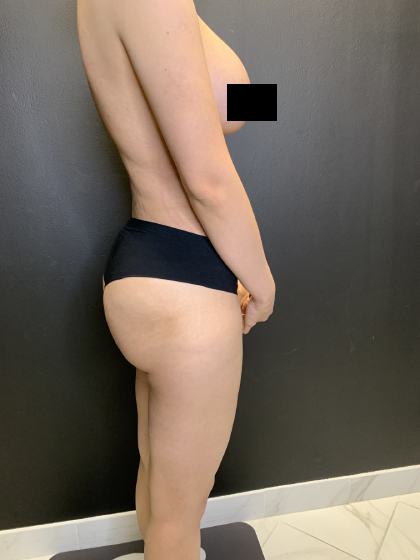 Brazilian Butt Lift Before & After Patient #10744